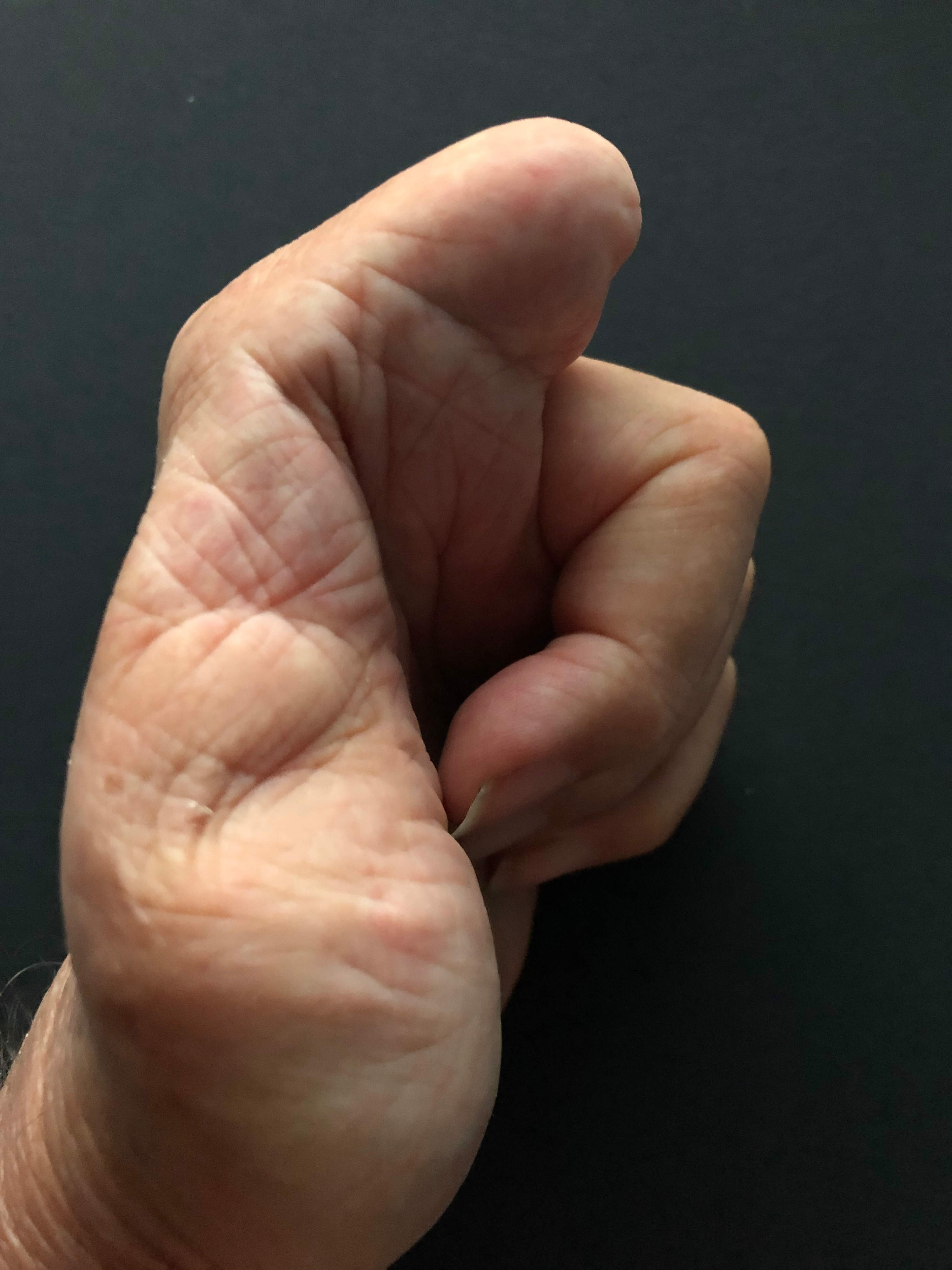 Hand mit amputiertem Zeigefinger